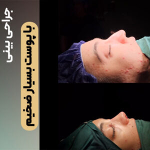 عکس عمل بینی گوشتی - دکتر فرید قاضی وکیلی - dr-faridghazivakili.com