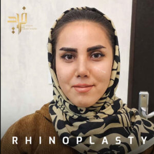 عکس نمونه کار عمل بینی گوشتی - دکتر فرید قاضی وکیلی- dr-faridghazivakili.com