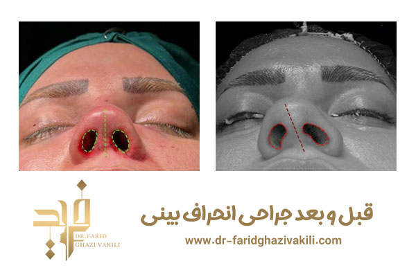 جراحی انحراف بینی در تبریز + دکتر فرید قاضی وکیلی