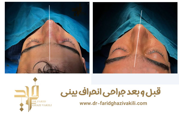 جراحی انحراف بینی در تبریز + دکتر فرید قاضی وکیلی