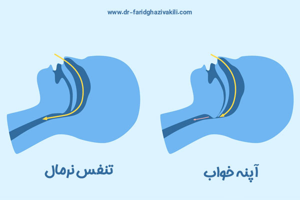درمان آپنه خواب در تبریز و مراغه + دکتر فرید قاضی وکیلی 