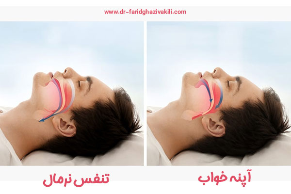 درمان آپنه خواب در تبریز و مراغه + دکتر فرید قاضی وکیلی 