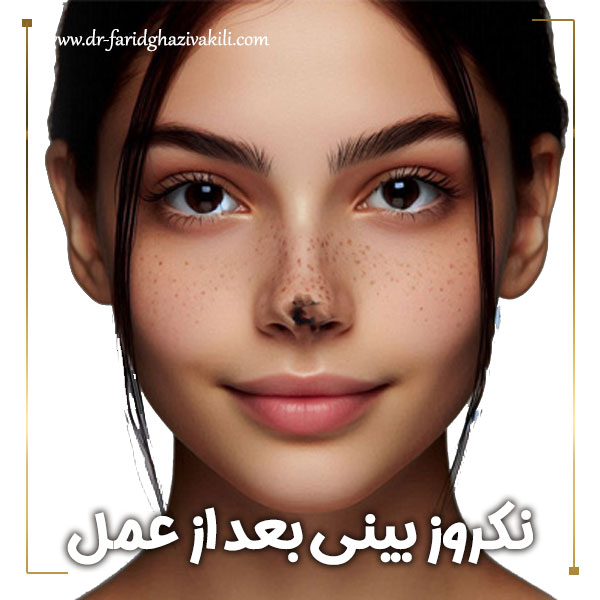 نکروز بینی بعد از عمل + دکتر فرید قاضی وکیلی