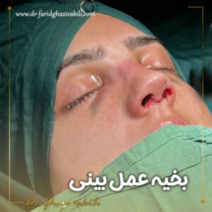 بخیه‌ عمل بینی + دکتر فرید قاضی وکیلی