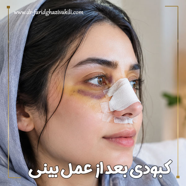 کبودی بعد از عمل بینی + دکتر فرید قاضی وکیلی