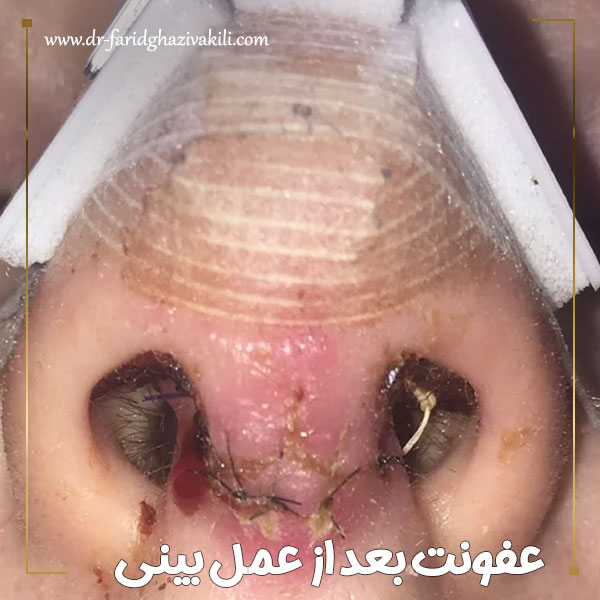 عفونت بعد از عمل بینی + دکتر فرید قاضی وکیلی