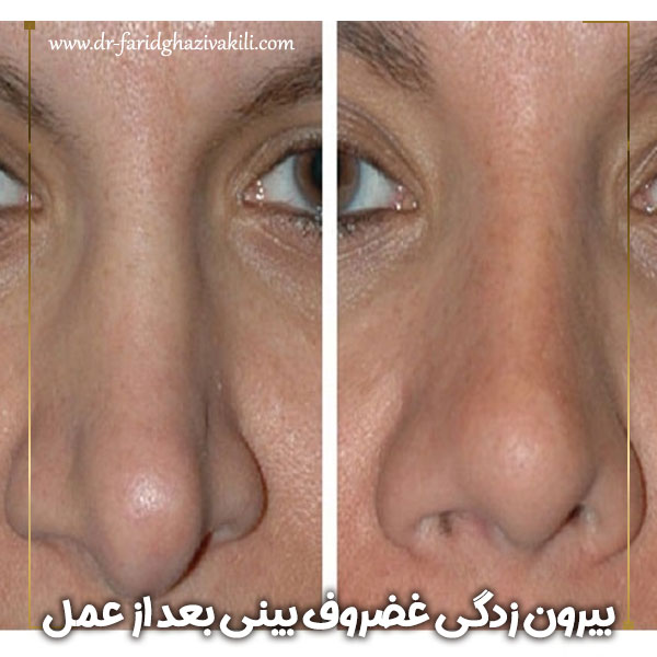 بیرون زدگی غضروف بینی بعد از عمل + دکتر فرید قاضی وکیلی
