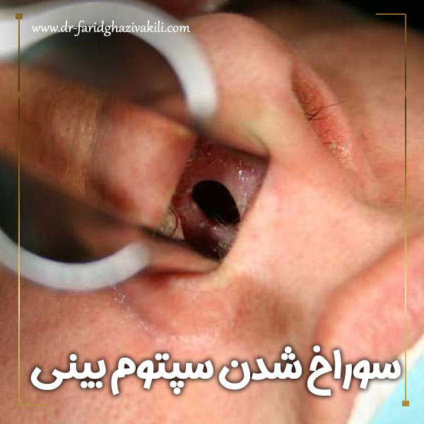 سوراخ شدن سپتوم + دکتر فرید قاضی وکیلی