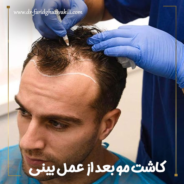 کاشت مو بعد از عمل بینی + دکتر فرید قاضی وکیلی