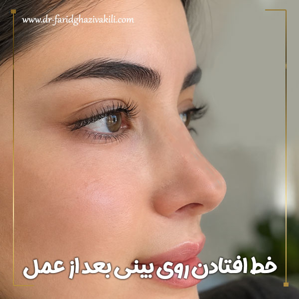 خط افتادن روی بینی بعد از عمل + دکتر فرید قاضی وکیلی