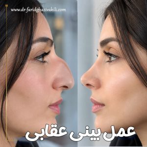 عمل بینی عقابی در تبریز | دکتر فرید قاضی وکیلی